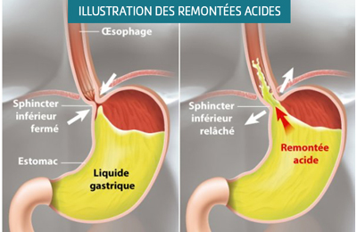 Acidite Gastrique Reomontees Acides Rgo Quelles Solutions