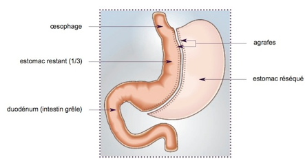 Sleeve gastrectomie