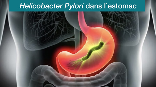 Helicobacter Pylori dans l'estomac